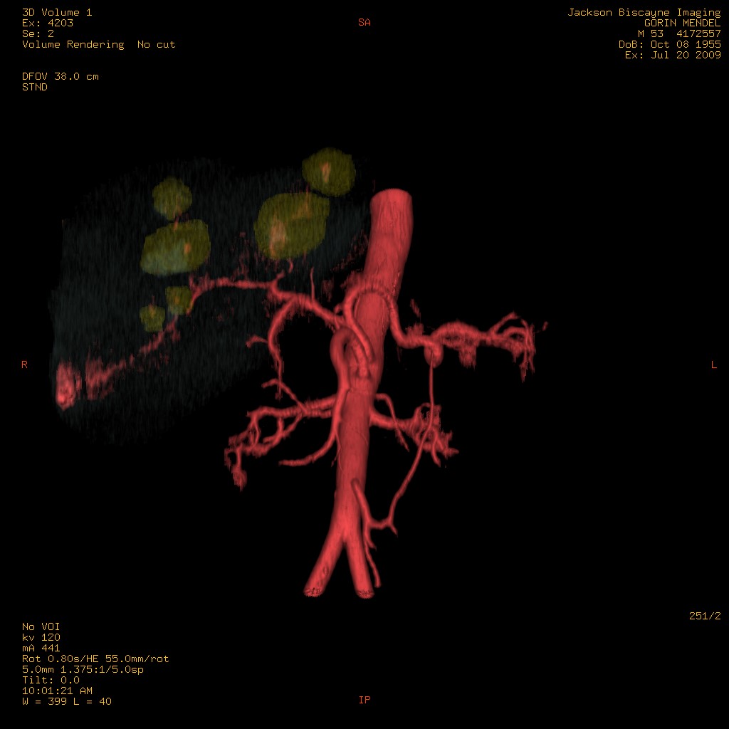 3D-Model of liver tumors and supplying vasculature.