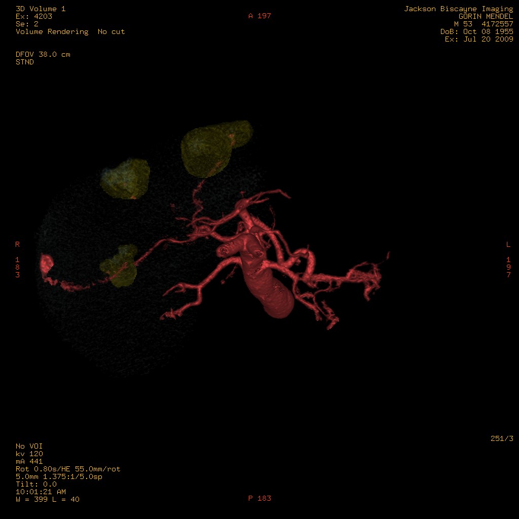 3D-Model of liver tumors and supplying vasculature.