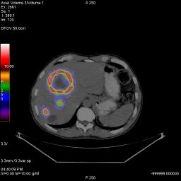 Coronal FDG PET/CT