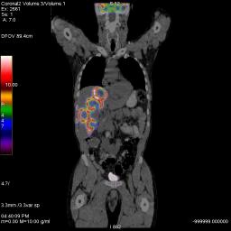 Planar FDG PET/CT